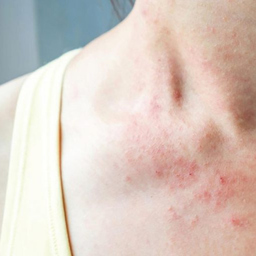 benhcham eczema